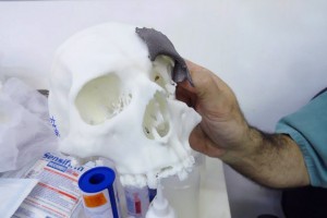Pr&oacute;tese foi fabricada em impressora 3D. Foto: Divulga&ccedil;&atilde;o Sesab 