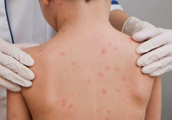 Bahia registra dois casos de meningite em cidade do interior