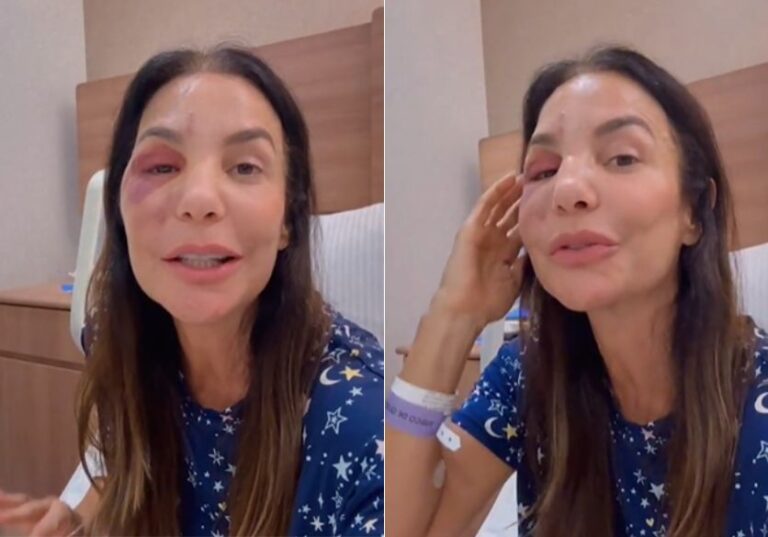 Após cirurgia, Ivete Sangalo explica fratura causada por desmaio…
