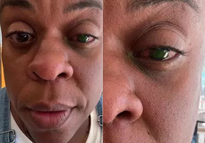 Cacau Protásio relata perda de visão após usar pomada capilar: ‘Dor insuportável’