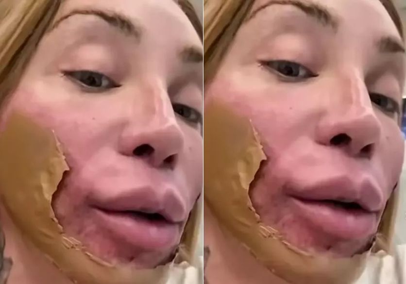 Maya Massafera revela procedimento que ‘remove a pele’ para regeneração; entenda