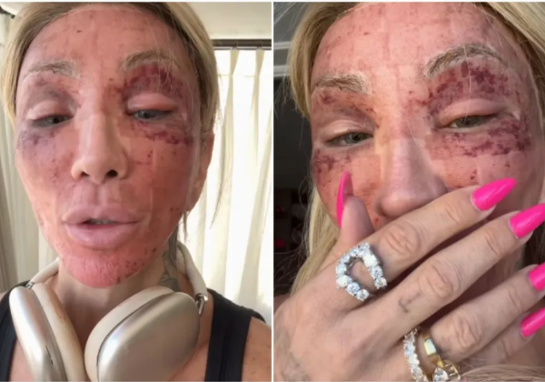 Maya Massafera mostra rosto inchado após peeling e choca fãs; veja